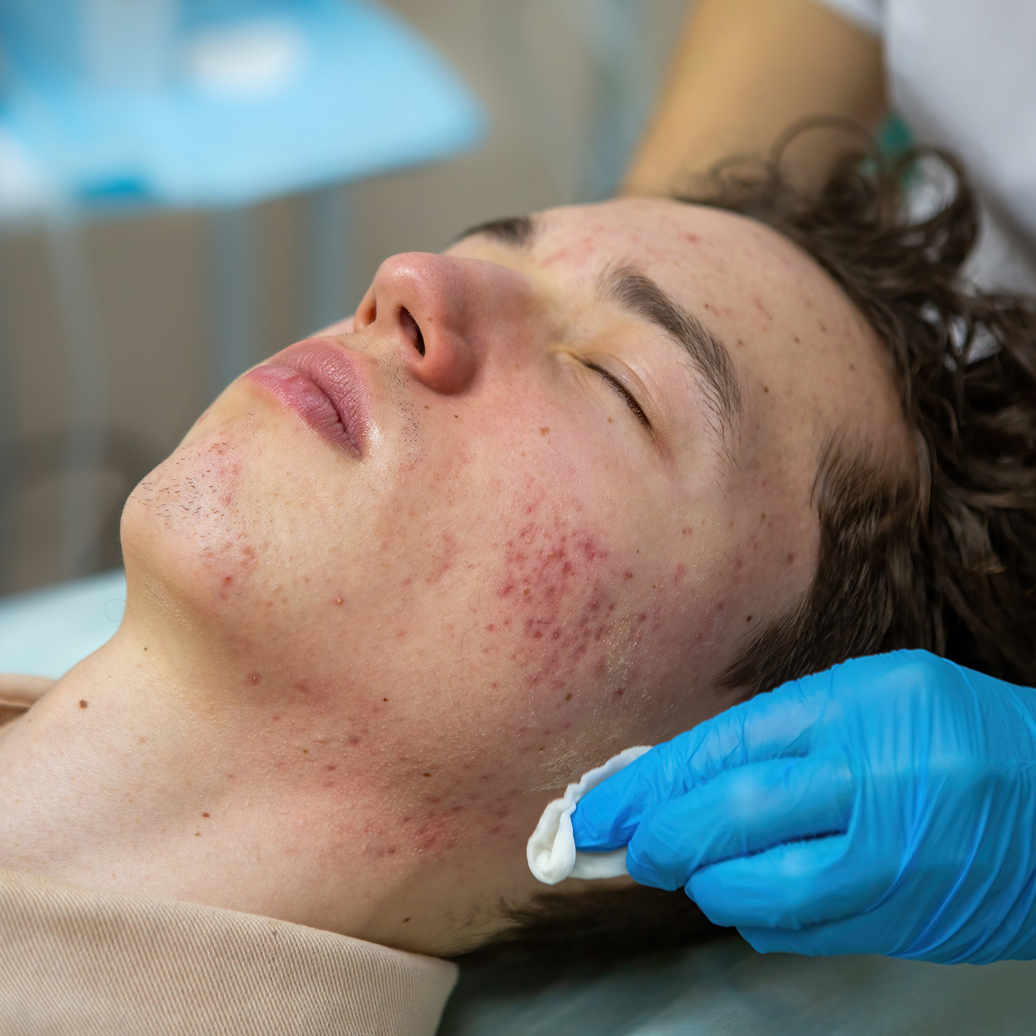 Soin dermatologique acné